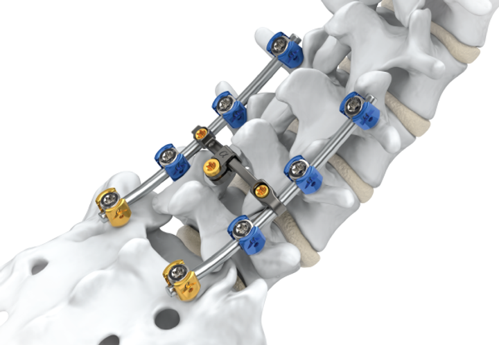 Spinal Fusion Surgery