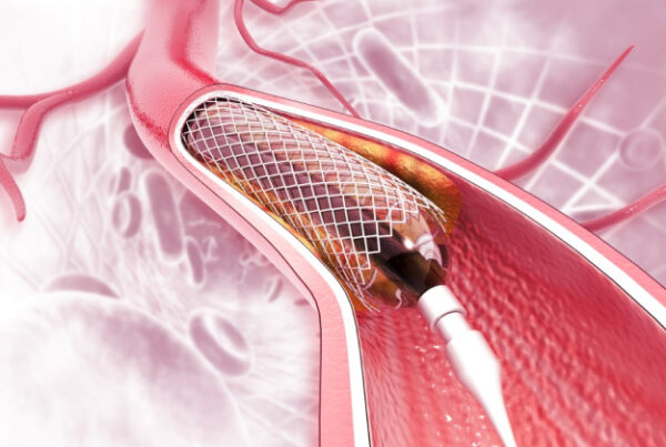 تركيب الشبكات القلبية