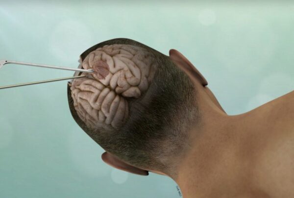 Brain Tumor Resection