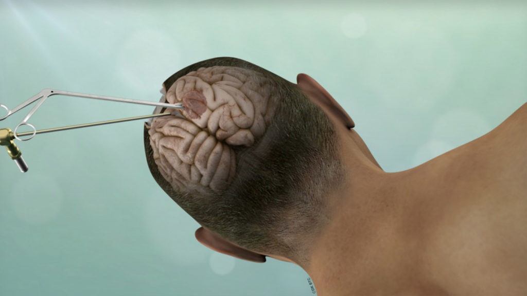 Brain Tumor Resection