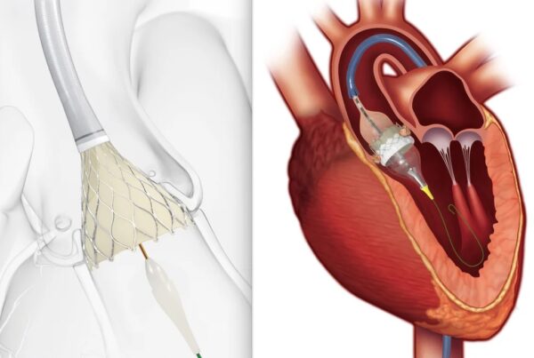 استبدال غطاء القلب بالقسطرة