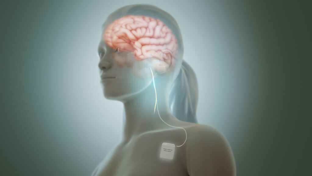 Vagus Nerve Stimulation (VNS) for Epilepsy