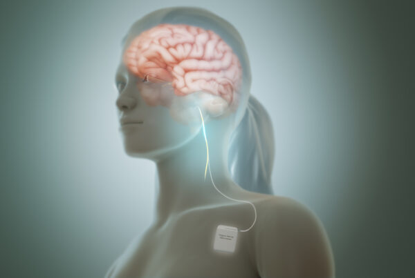 Vagus Nerve Stimulation (VNS) for Epilepsy