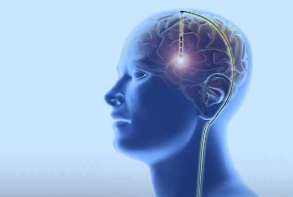 Deep Brain Stimulation