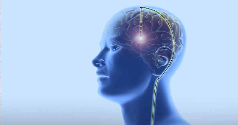 Deep Brain Stimulation