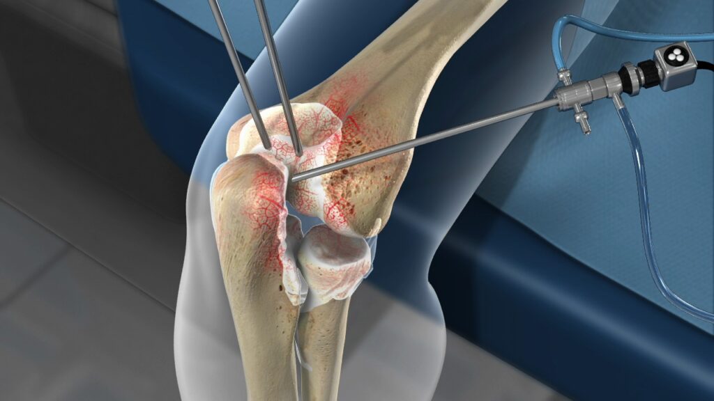 Arthritis Surgery