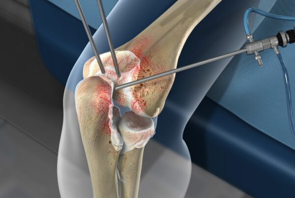 Arthritis Surgery