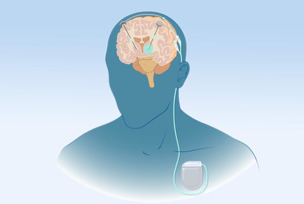 عملية بطارية الصرع