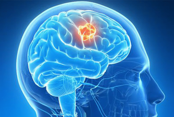 استئصال الأورام الدماغية