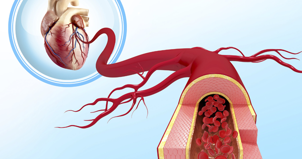 Endovascular Artery Replacement