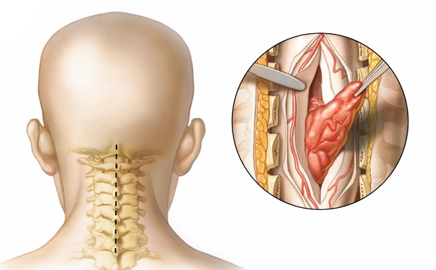 Spinal Cord Tumor Resection