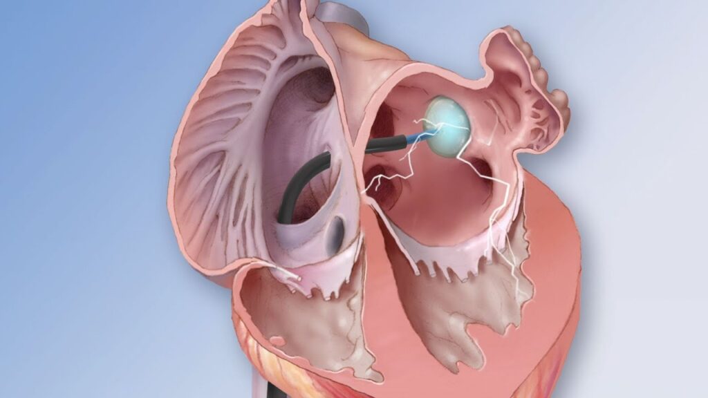 Cryoablation