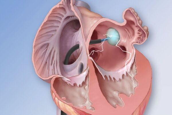 تبريد جدار القلب (Cryoablation)