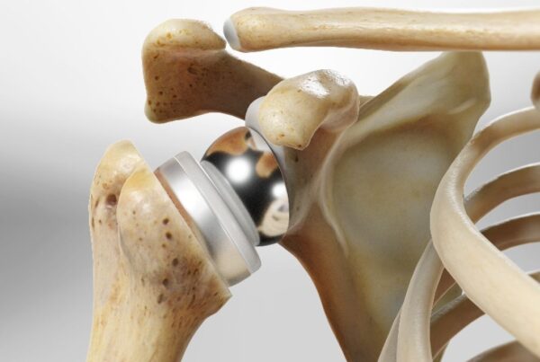 عملية استبدال مفصل الكتف