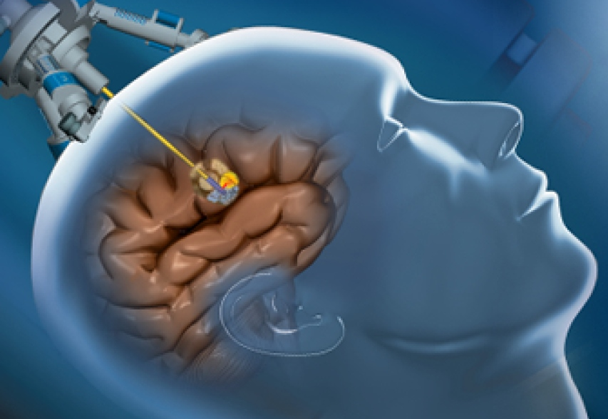 Brain Tumor Removal