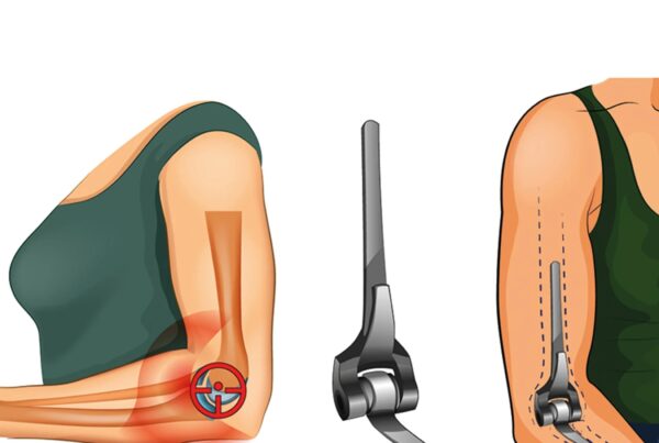عملية استبدال مفصل الذراع